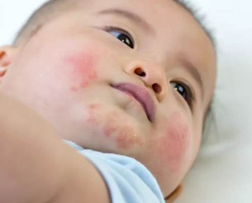 Eczema o dermatite nel bambino?
