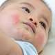 Eczema o dermatite nel bambino?